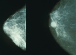 Crean sistema con alto rango de fiabilidad para la detección del cáncer de mama