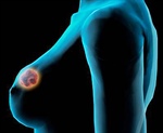 Resultados positivos en el combate al cáncer de mama metastásico BRCA