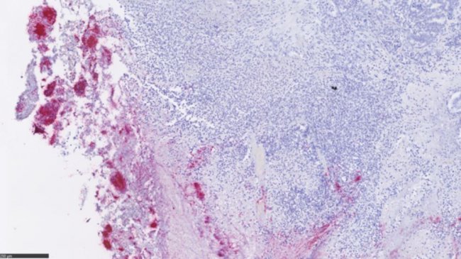Tumor colorrectal con gran número de Fusobacterium (en rojo) infiltrando el tumor. 